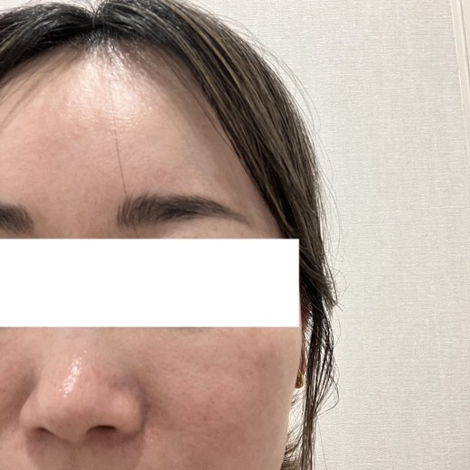 after photo: ララピール(LHAピーリング)