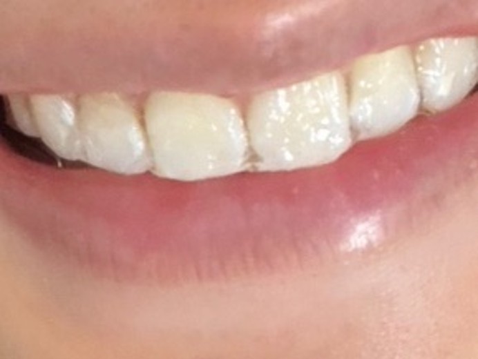 before photo: ホワイトニング