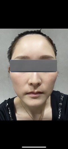 before photo: ララピール(LHAピーリング)