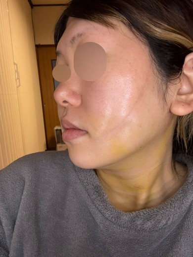 after photo: 糸リフト, 脂肪吸引(顎下), 脂肪吸引(顔), 脂肪吸引(頬)