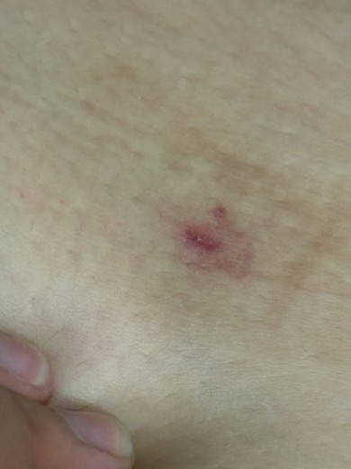 after photo: 팔지방흡입, 옆구리지방흡입, 복부지방흡입, 허리지방흡입