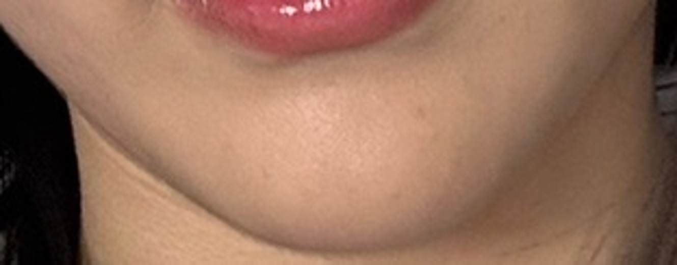 after photo: 윤곽주사