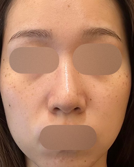 マッサージピール＋エレクトロポレーション（レナトスTA） | M's