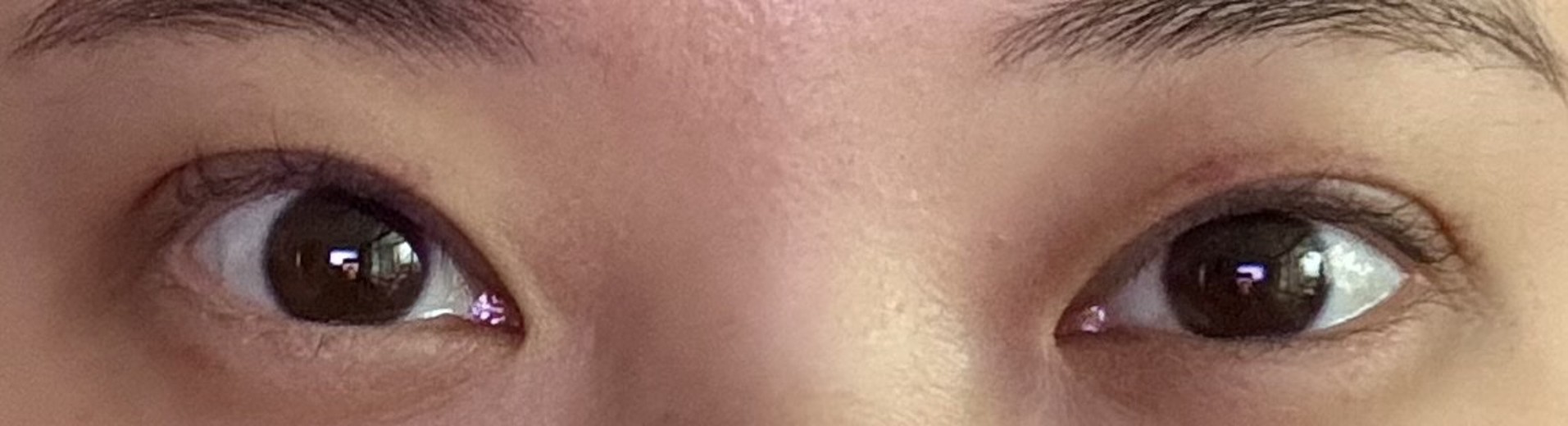 after photo: 눈재수술, 눈매교정