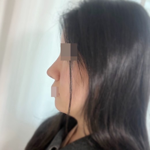 after photo: 코재수술, 콧대(보형물), 복코교정(수술)