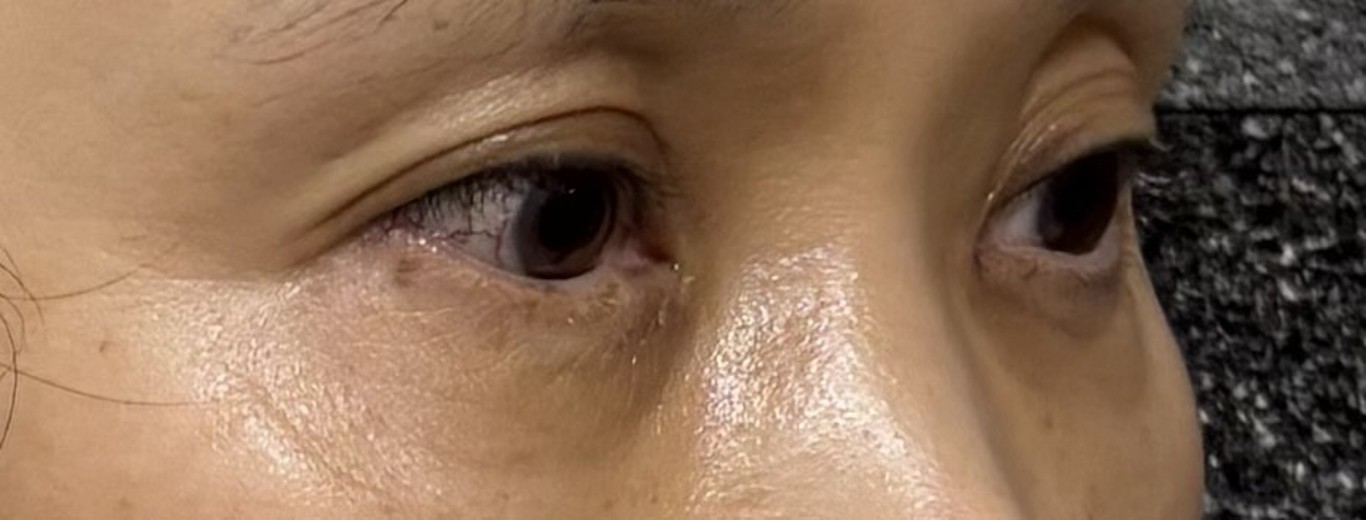 after photo: 눈밑지방재배치