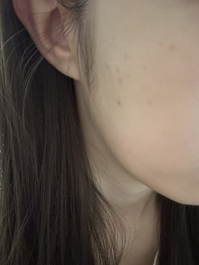 after photo: 피코토닝, 레이저토닝, 제네시스