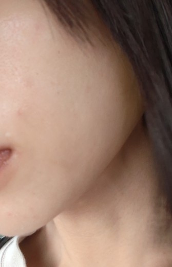 after photo: 糸リフト, メーラー/ジョール/バッカルファット除去