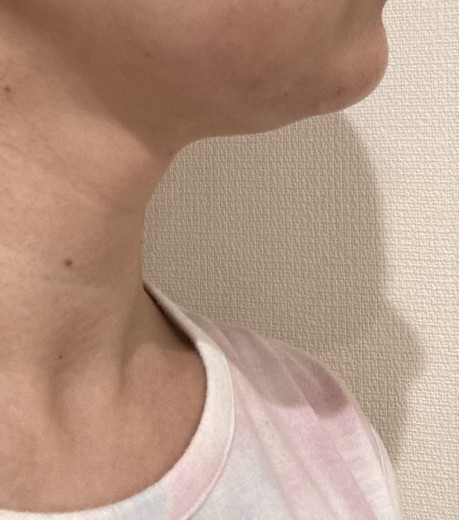 after photo: 脂肪溶解注射(顔)