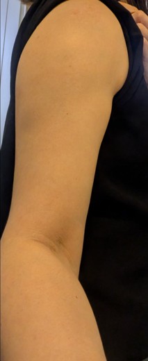 after photo: 脂肪冷却(腕)