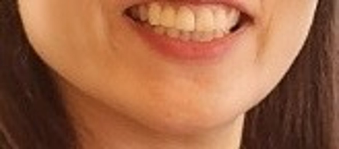 before photo: 윤곽주사