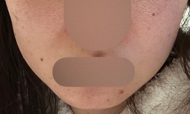 再来OK】ハイドラフェイシャル＋エレクトロポレーション | おおかみ