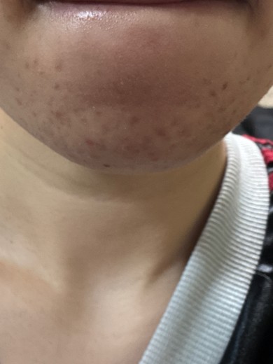 after photo: ダーマペン
