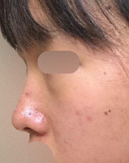 before photo: ルメッカ