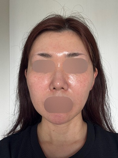 after photo: IPL(光/フォト治療), ルメッカ