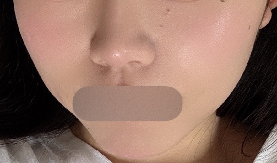 after photo: ほうれい線ヒアルロン酸