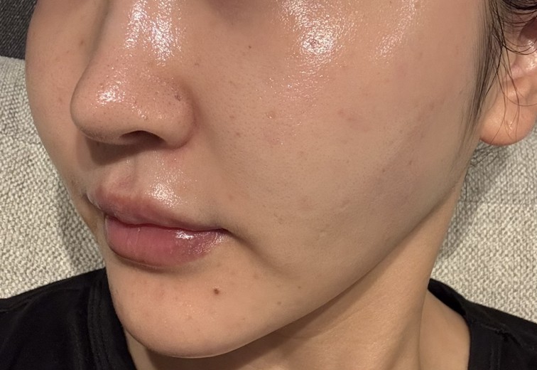 after photo: ジュベルック(Juvelook)