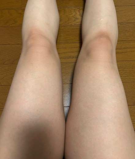 before photo: 脂肪冷却(太もも)