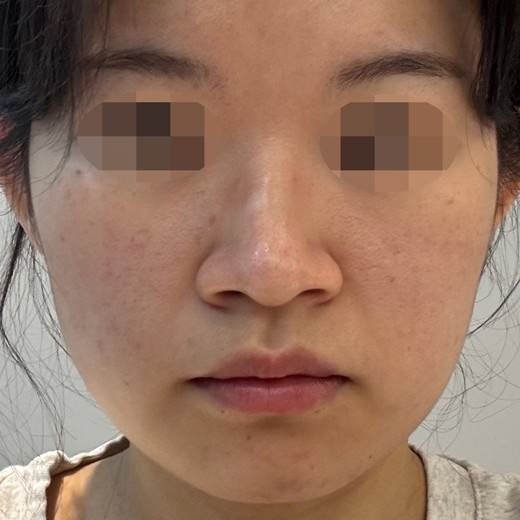 before photo: 콧볼축소