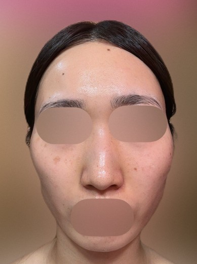 after photo: ハイドラフェイシャル, 診断・検査