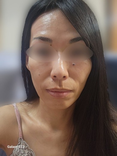 after photo: 水光注射