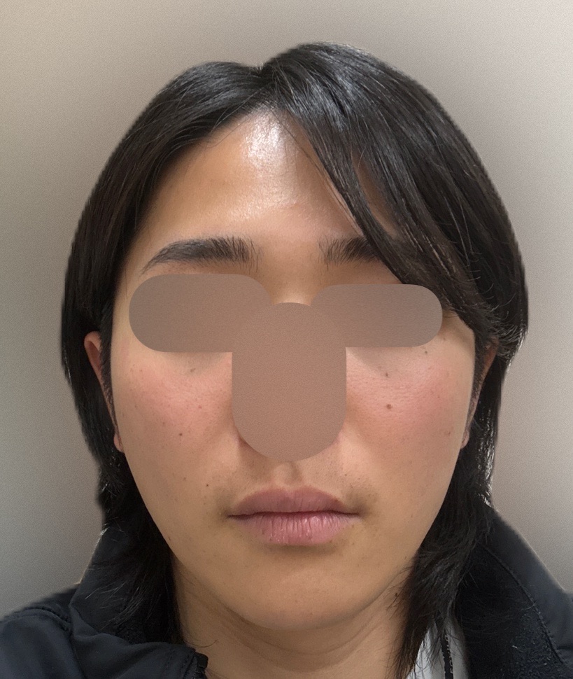 何度でも可】【男性限定】顔全体脱毛(髭全体+鼻+額)ジェントル 何度でも可】【男性限定】顔全体脱毛(髭全体+鼻+額)ジェントル
