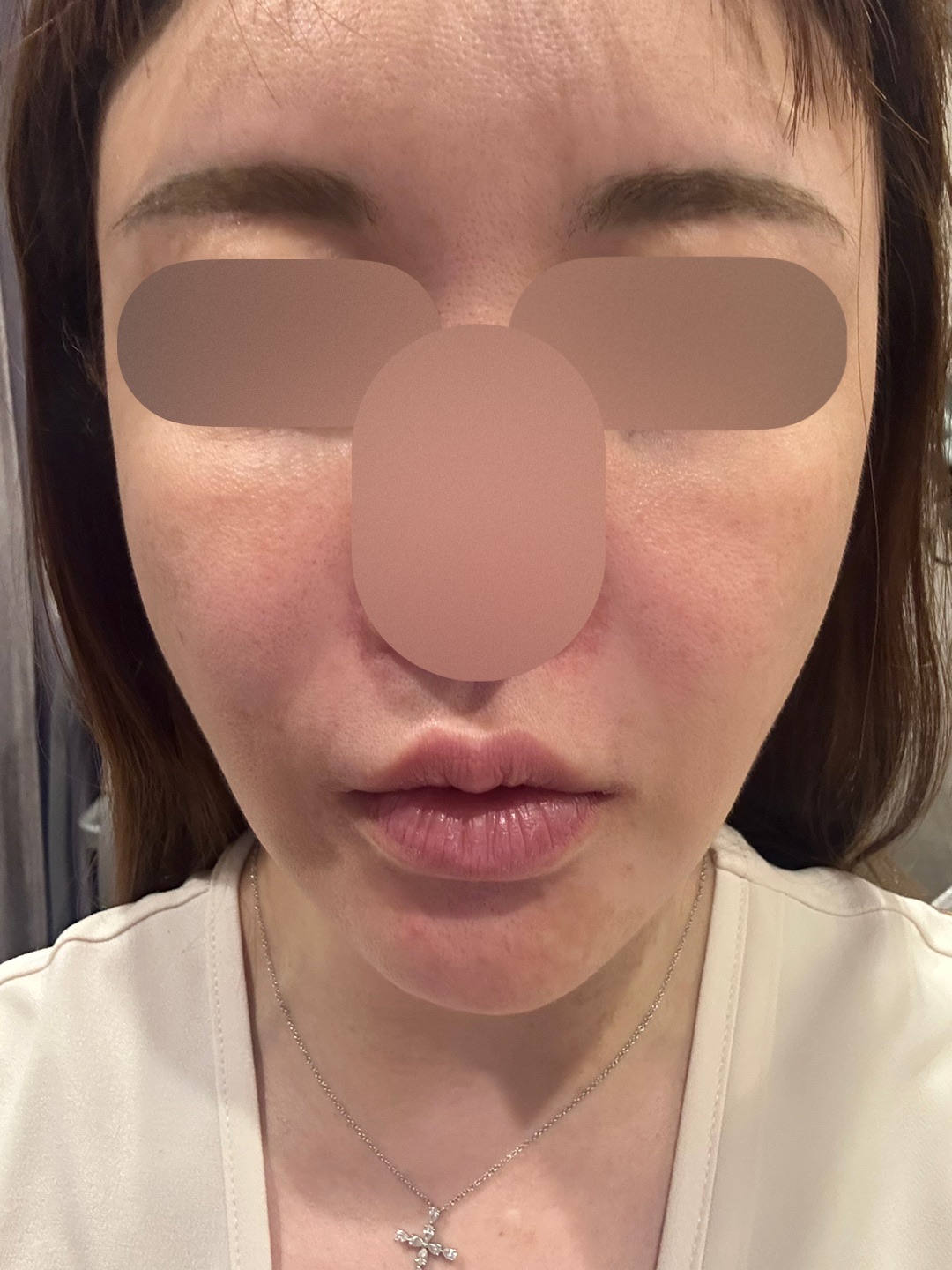 フォトフェイシャル ステラM22（全顔） | mywclinic〔ミュー