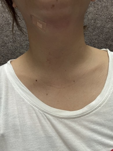 after photo: 脂肪吸引注射