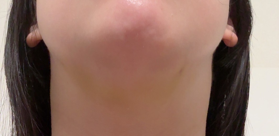after photo: 脂肪溶解注射(顔)