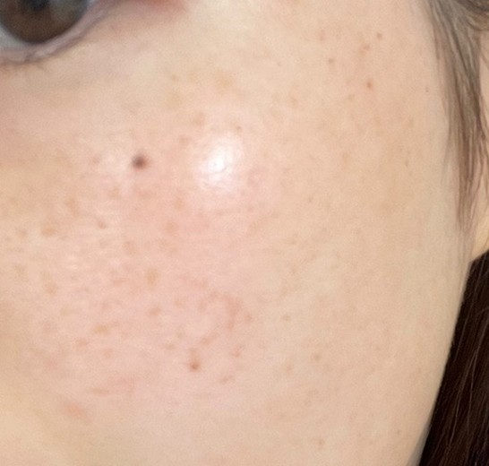 after photo: IPL(光/フォト治療), ピーリング, ルメッカ