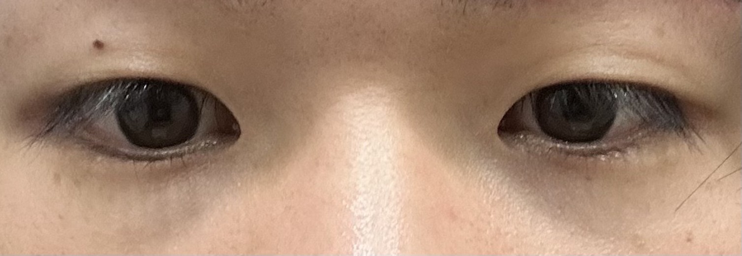after photo: 眼瞼下垂(目つき矯正)