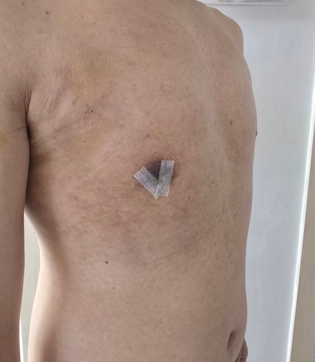 after photo: 여유증수술