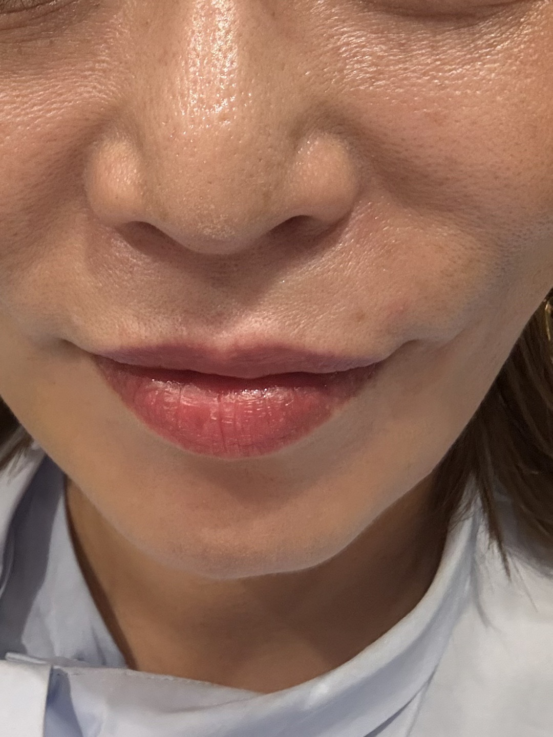 ボトックス（口角・ガミー・上口唇） | PRO CLINIC【プロクリニック】