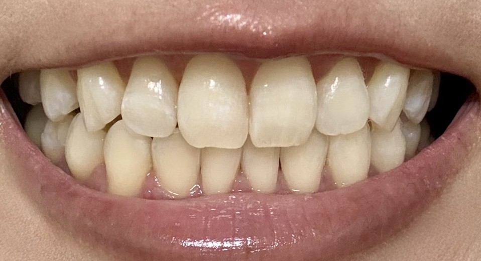 after photo: ホワイトニング