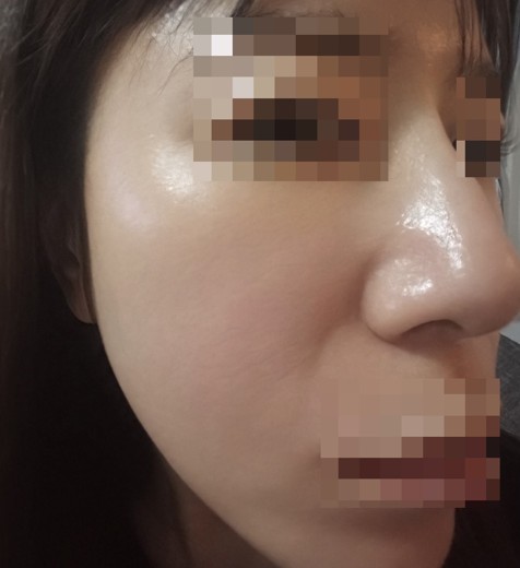 after photo: IPL(光/フォト治療), ピーリング, エレクトロポレーション