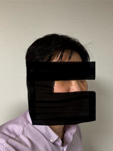 after photo: 눈밑지방재배치