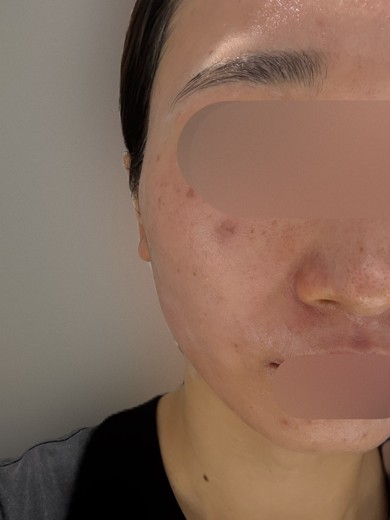 after photo: ハイドラフェイシャル, 診断・検査