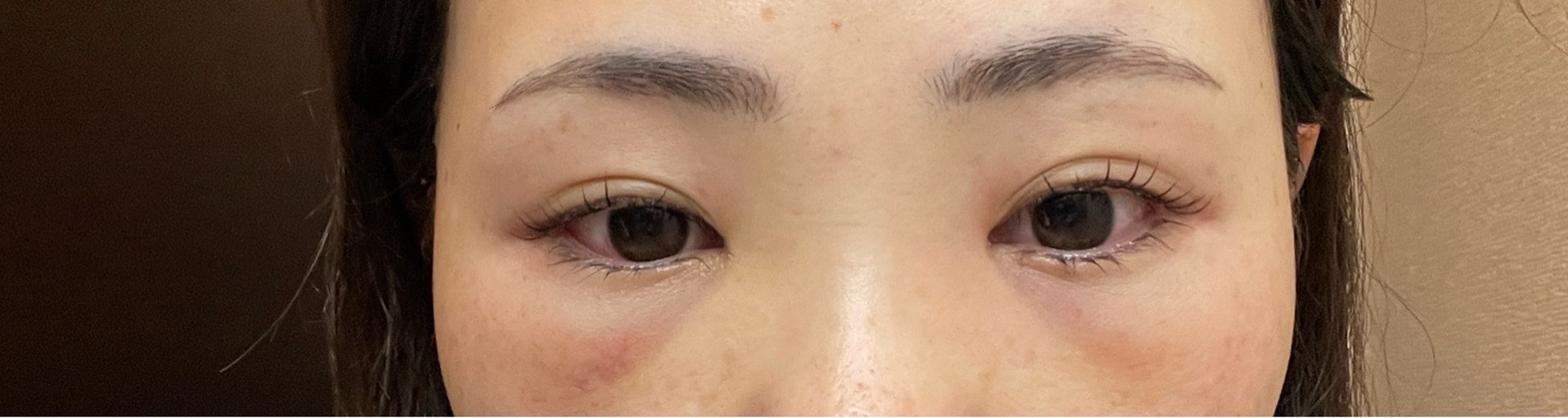 after photo: 脱脂(クマ治療)