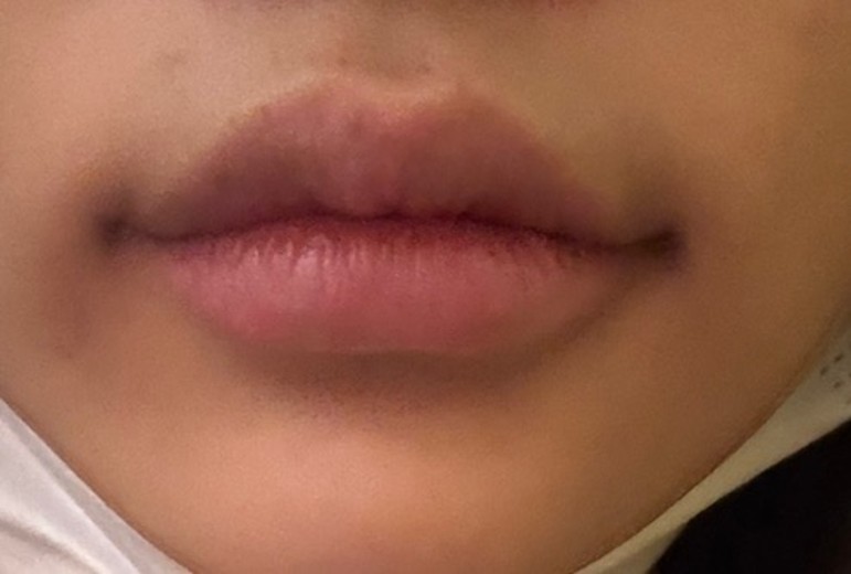 after photo: 실리프팅