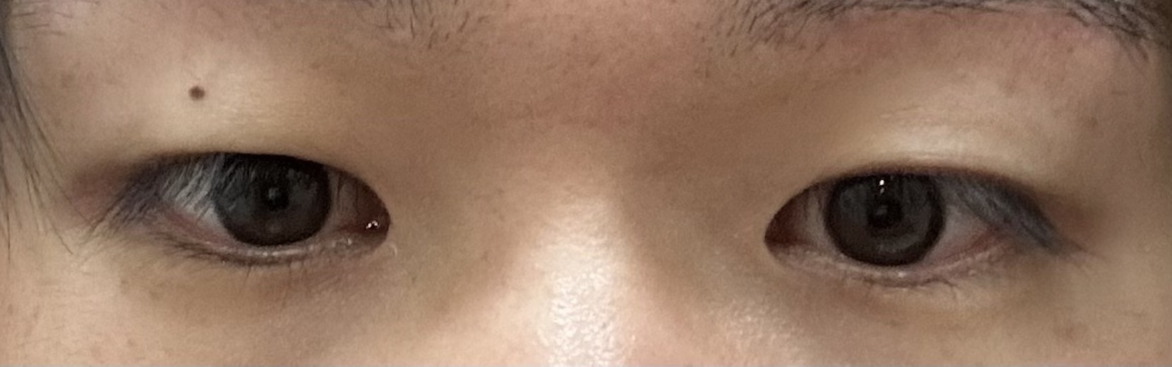 after photo: 眼瞼下垂(目つき矯正)