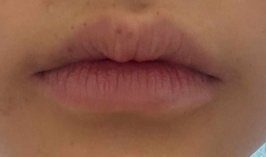 before photo: 실리프팅