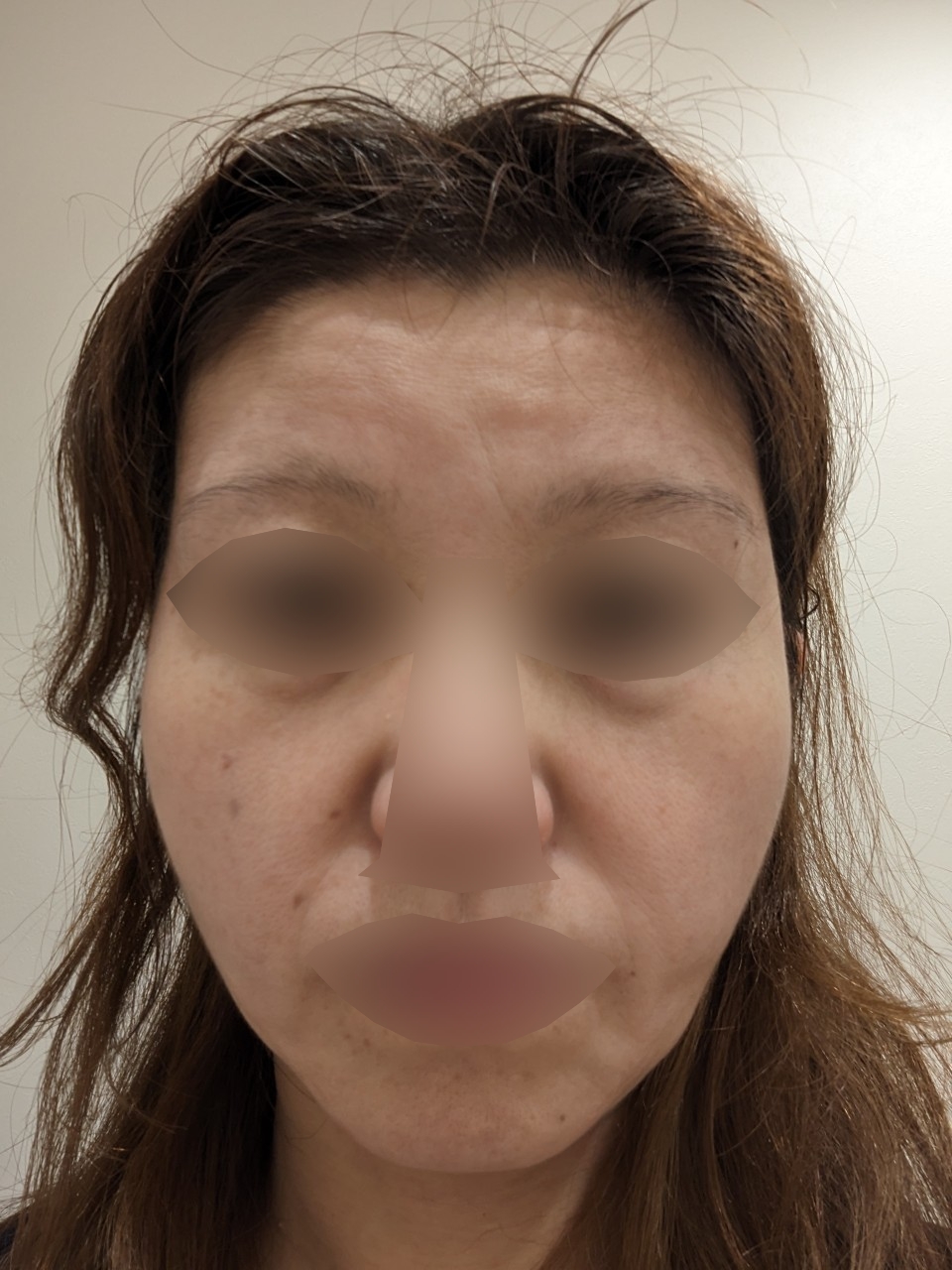 マッサージピール ｜1回・3回・5回 | ヴァージンクリニック広島院