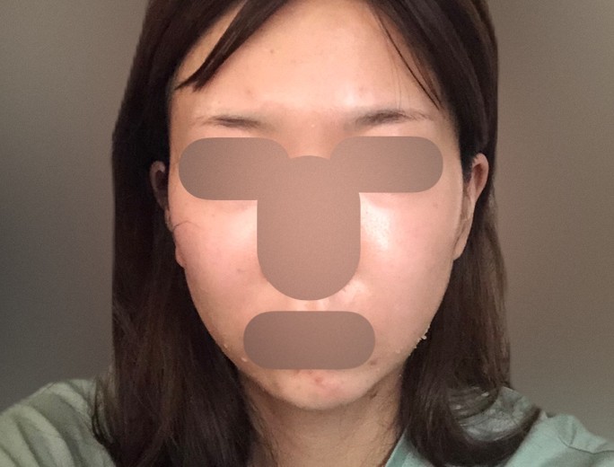 after photo: IPL(光/フォト治療)