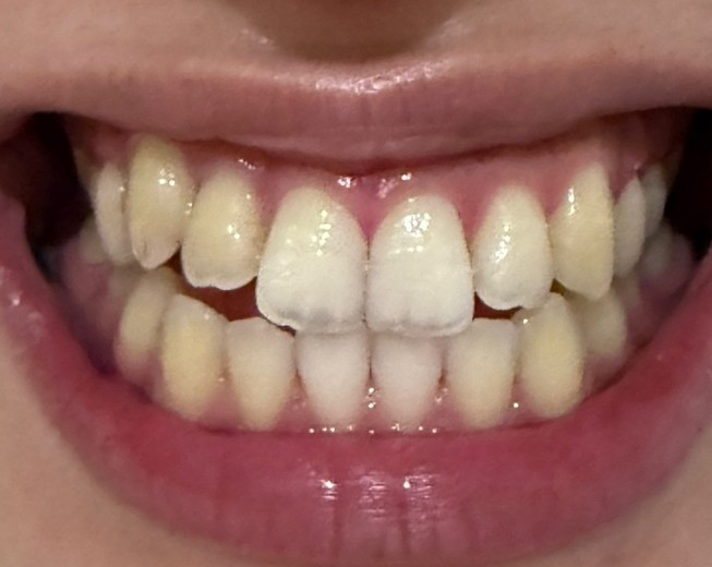 before photo: ホワイトニング