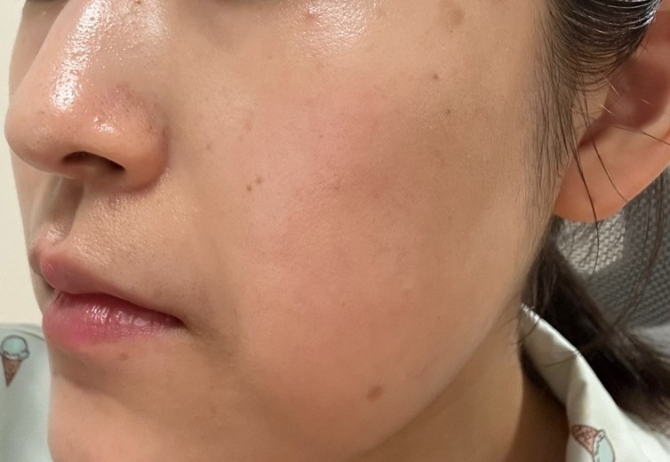 before photo: ピコスポット