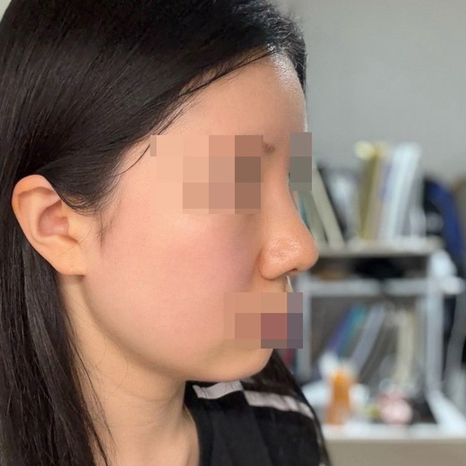 after photo: 코재수술, 콧대(보형물), 복코교정(수술)