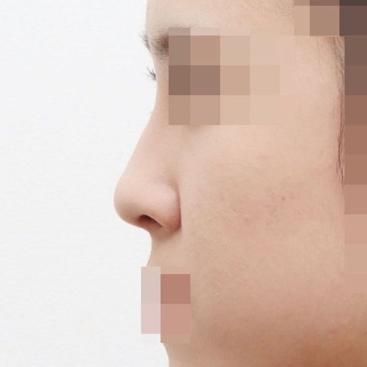 before photo: 콧대(자가조직), 콧대(보형물)