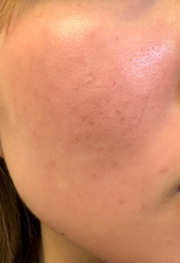 before photo: ダーマペン