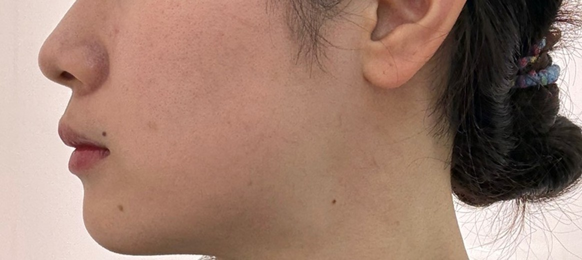 before photo: チタニウムリフト