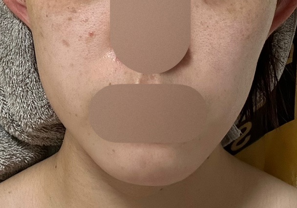 再来OK】エラ ボツリヌストキシン注射 | シティタワー新宿クリニック